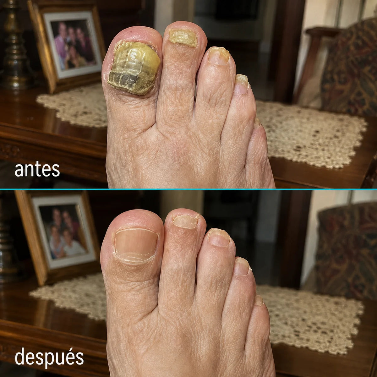 Nailux™ La luz que por fin llega bajo la uña — vuelve a enseñar los pies sin taparlos + Hoy incluye GRATIS aceite natural que acelera el proceso