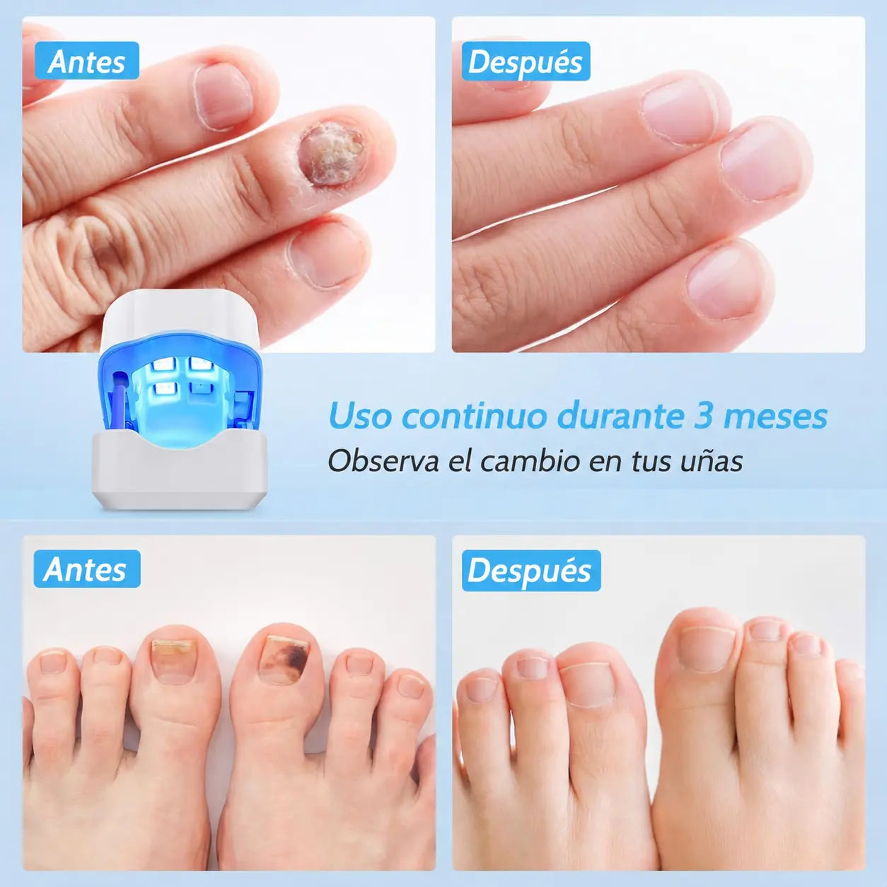 Nailux™ La luz que por fin llega bajo la uña — vuelve a enseñar los pies sin taparlos + Hoy incluye GRATIS aceite natural que acelera el proceso