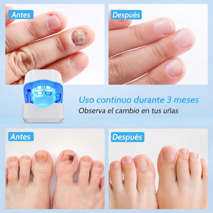 Nailux™ La luz que por fin llega bajo la uña — vuelve a enseñar los pies sin taparlos + Hoy incluye GRATIS aceite natural que acelera el proceso